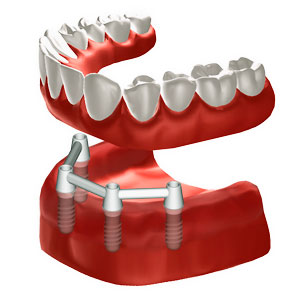 Zahnloser Unterkiefer mit 4 Implantaten zur Befestigung einer Vollprothese. © Institut Straumann AG, 2013. Alle Rechte vorbehalten. Mit freundlicher Genehmigung der Institut Straumann AG