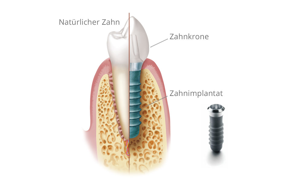 Zahn und Implantat.
© Institut Straumann AG, 2013. Alle Rechte vorbehalten. Mit freundlicher Genehmigung der Institut Straumann AG